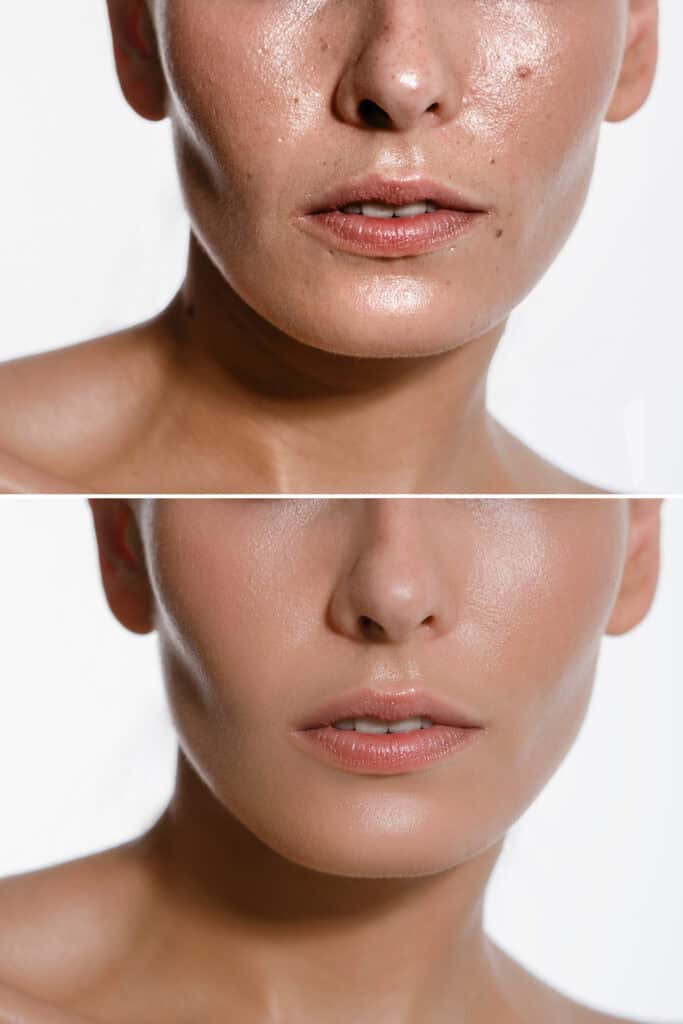 anonymous face showing before and after skin results