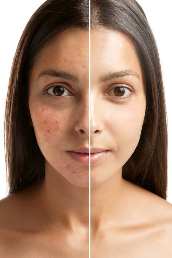 before and after face with blood vessels and red spots on the before face